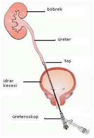 Genişletilmiş renal pelvis: nedenleri, tanı ve tedavi Genişletilmiş renal pelvis: nedenleri, tanı ve tedavi